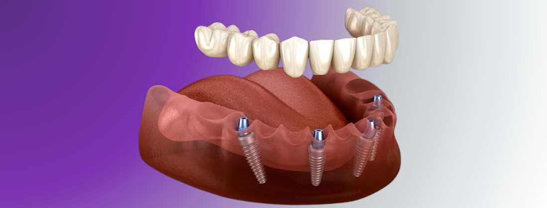 The Essential Technologies For All On X Dental Implant Procedures 